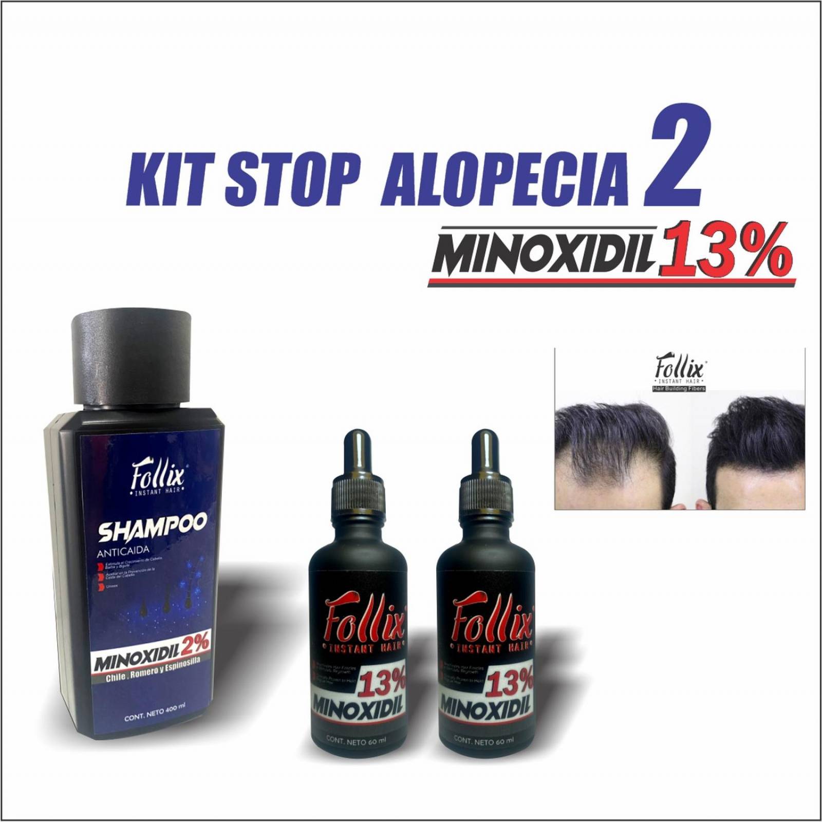 Kit Stop Alopecia 2, Con 2 Minoxidil 13 Y Shampoo Minoxidil 