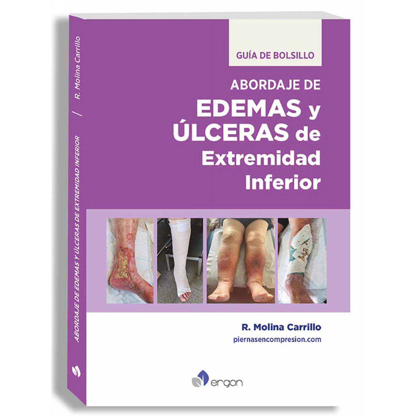 Abordaje de edemas y úlceras de extremidad inferior 