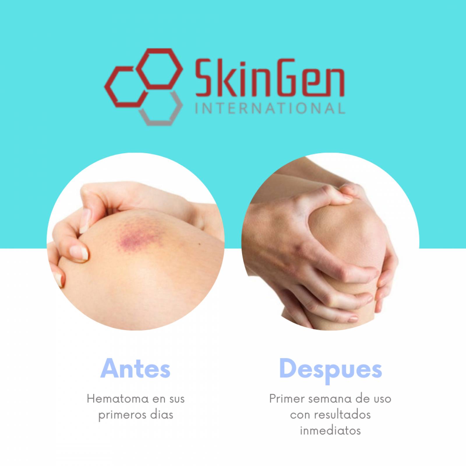 Hematix Gel 30g Desvanecedor De Moretones, Hematomas, Piel