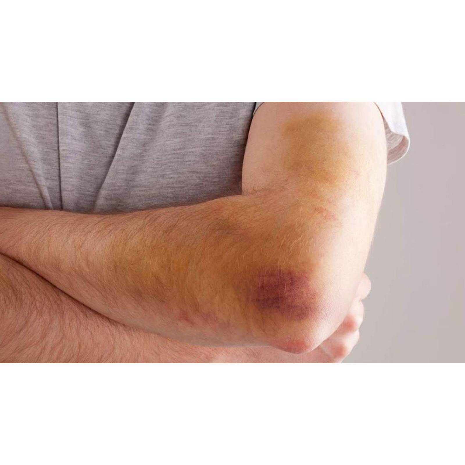 Hematix Gel 30g Desvanecedor De Moretones, Hematomas, Piel