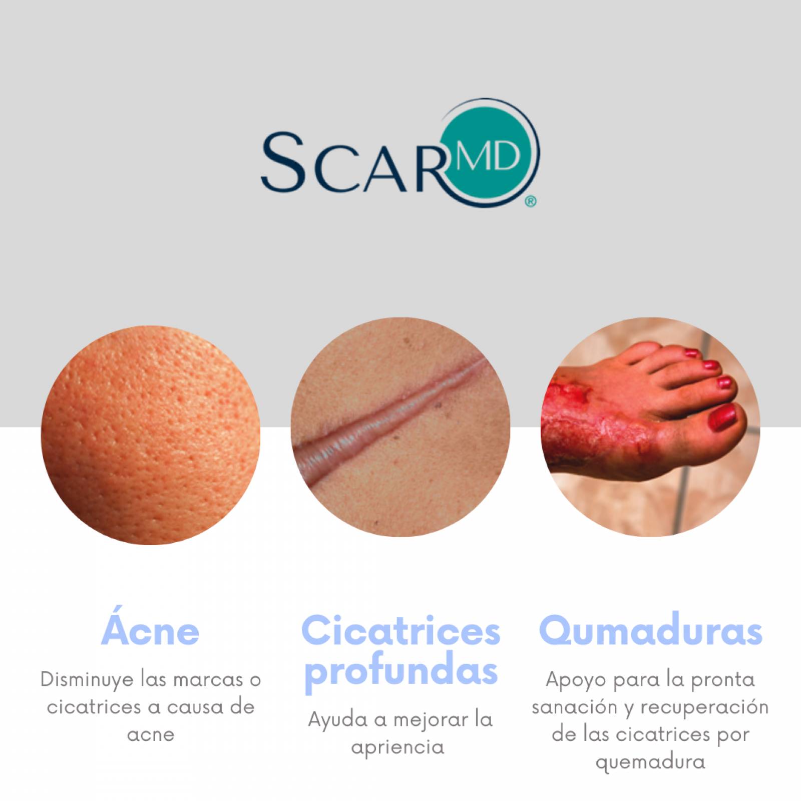 Scar MD Spray, Desvanecedor De Cicatrices Con Silicona, Piel 