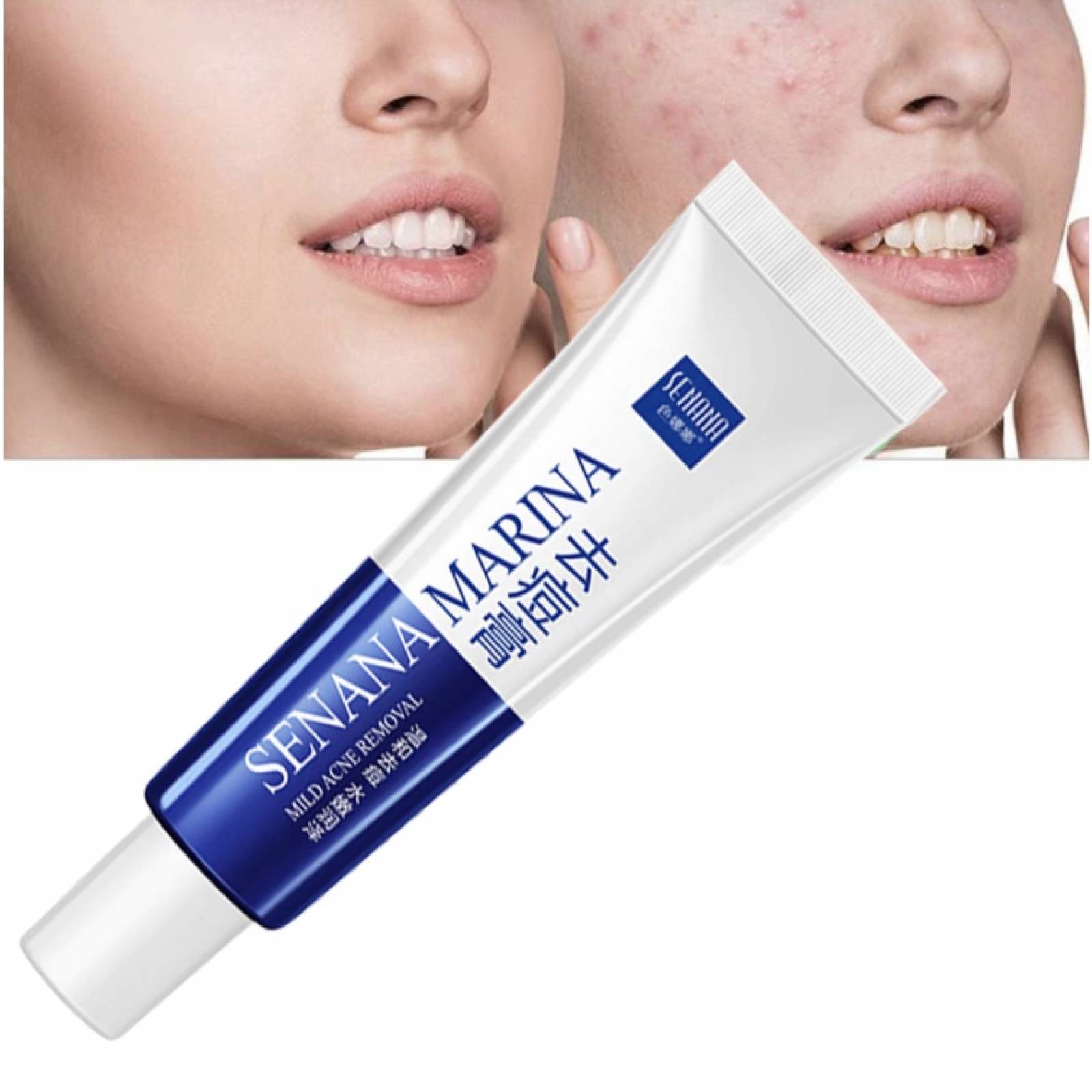 Crema Disminuye Acne Espinillas Senana Marina