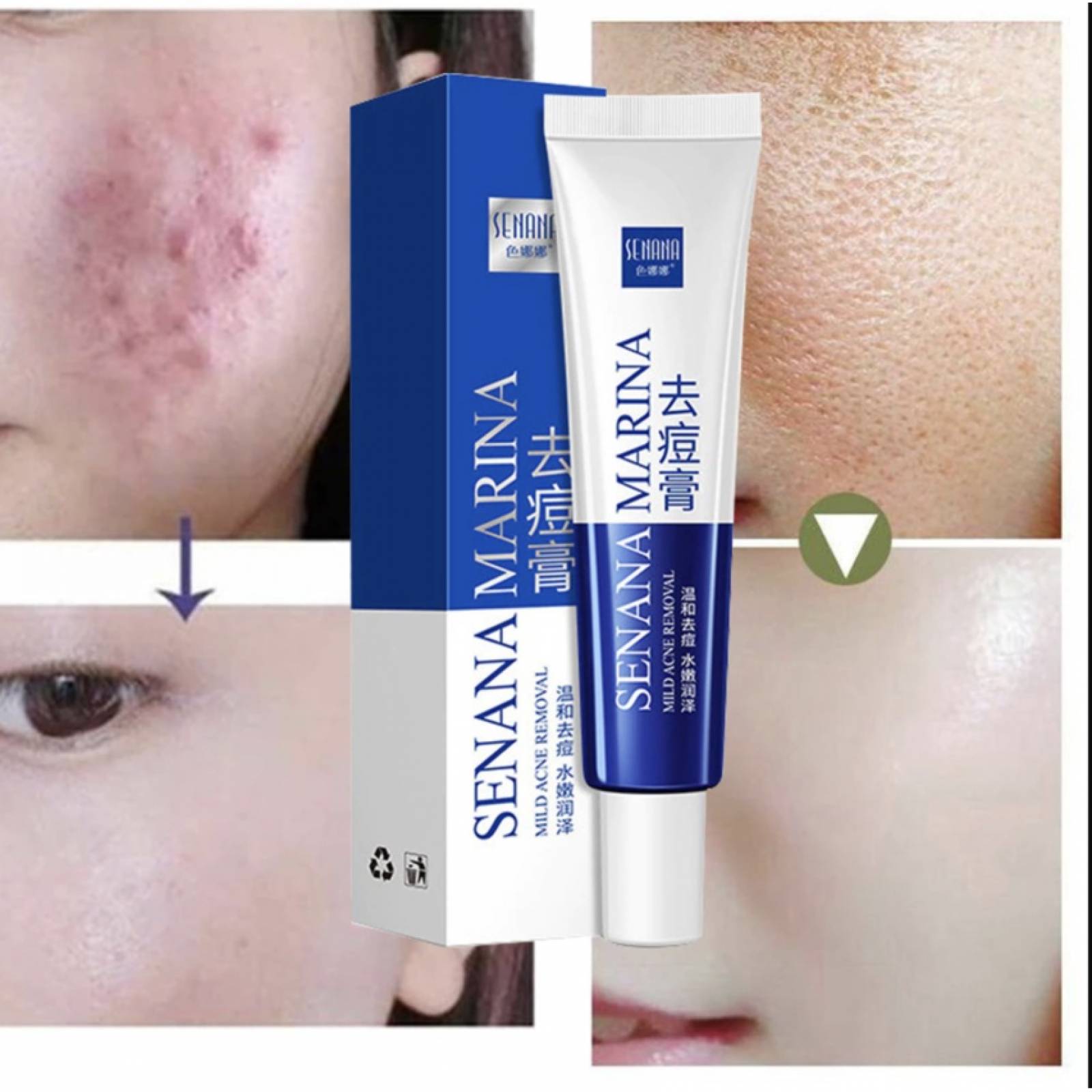 Crema Disminuye Acne Espinillas Senana Marina