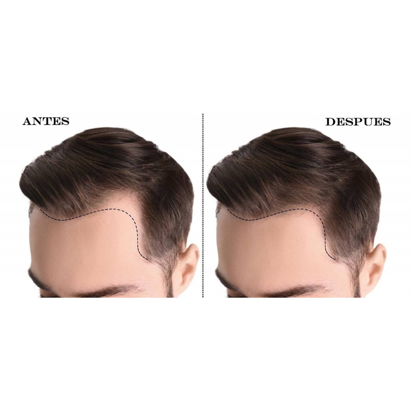 Kit Sistema Capilar Noxidil H2 Y Pomada Cabello Noxidil H2