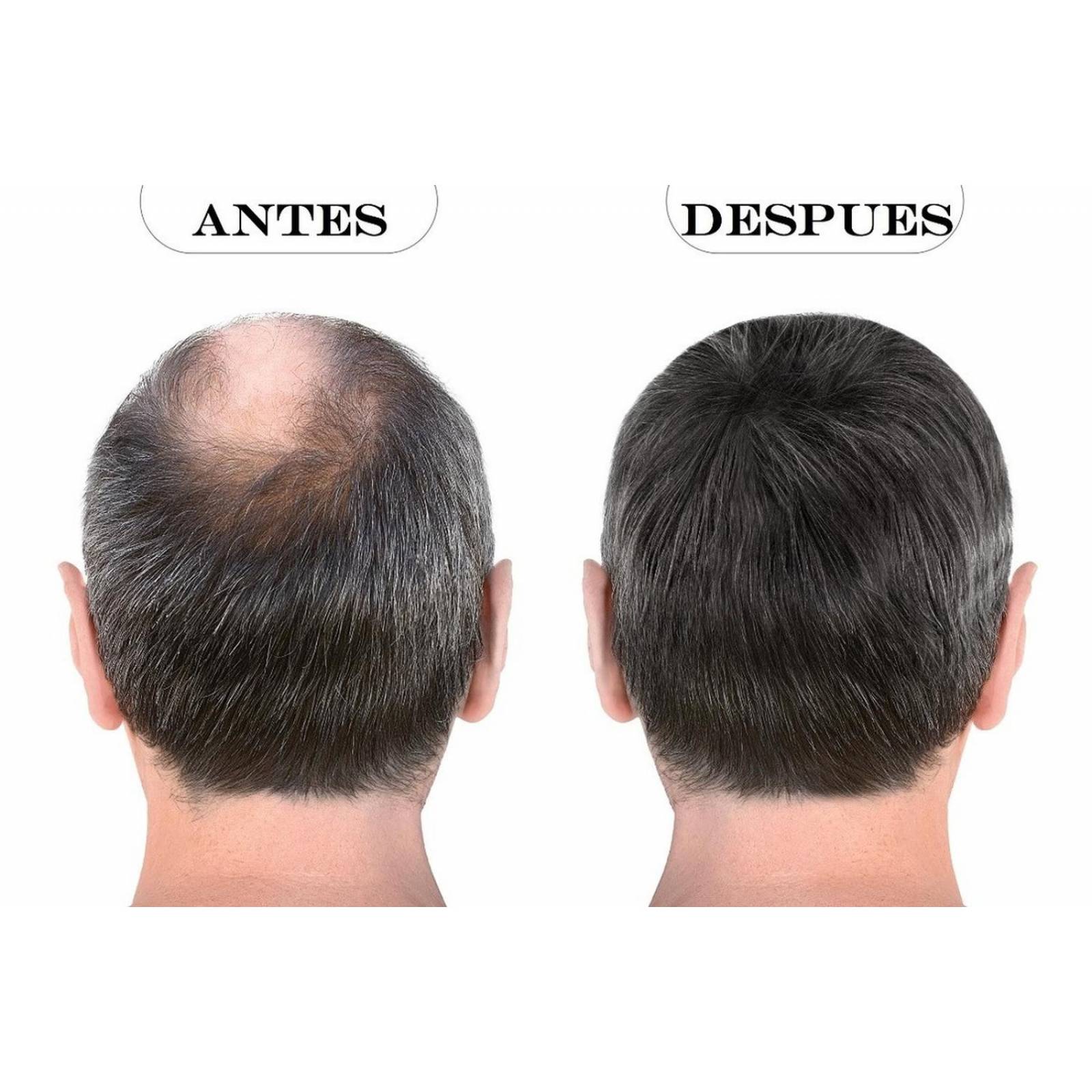 Kit Sistema Capilar Noxidil H2 Y Pomada Cabello Noxidil H2