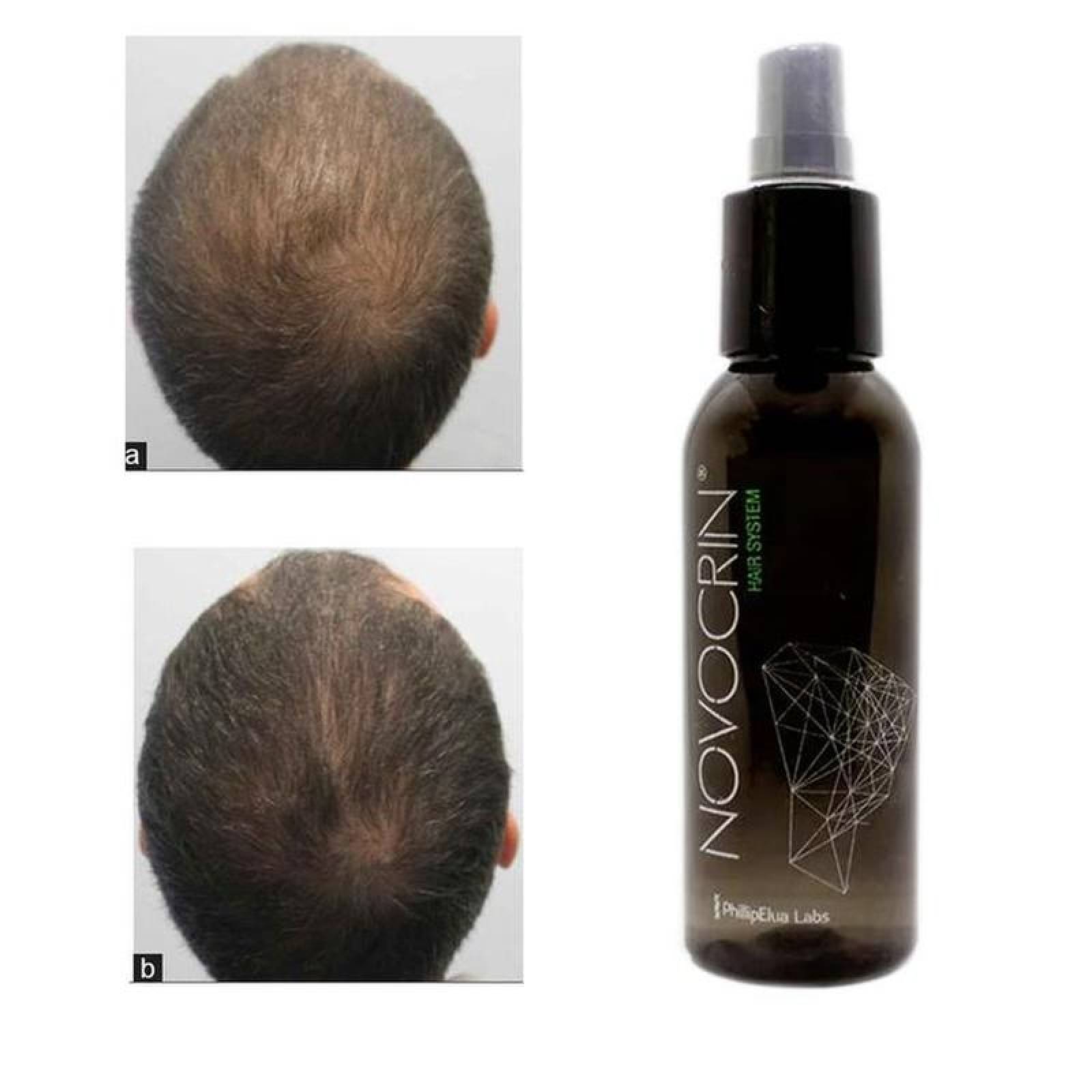 Locion Crecimiento Capilar cabello MXLTG-004-2 5 Pzs 100ml Loción Unisex Botella con Atomizador Uso Diario, LotionGrow