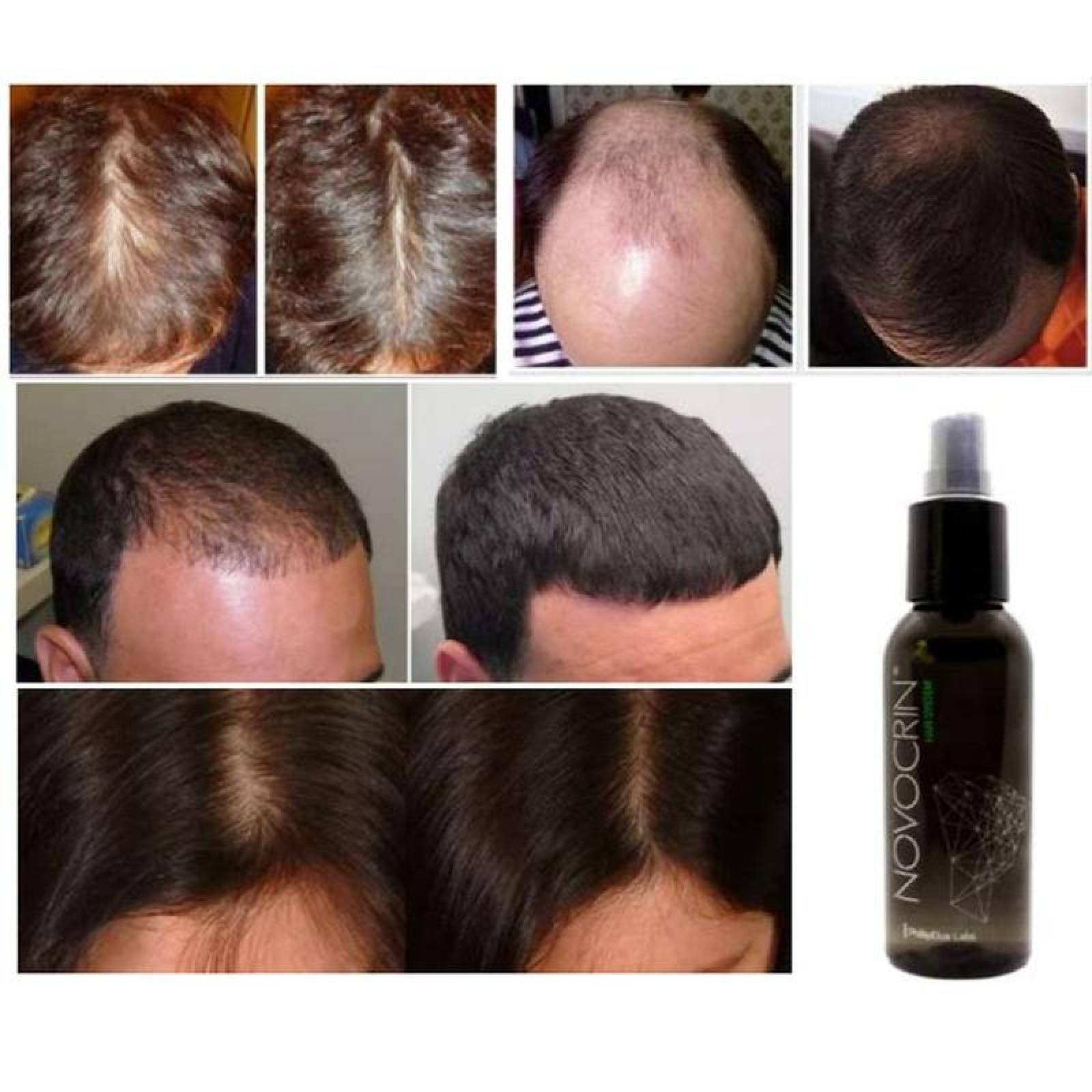 Spray para crecer cabello unisex MXLTG-004-4 5 Pzs 100ml Loción Unisex Botella con Atomizador Uso Diario, LotionGrow