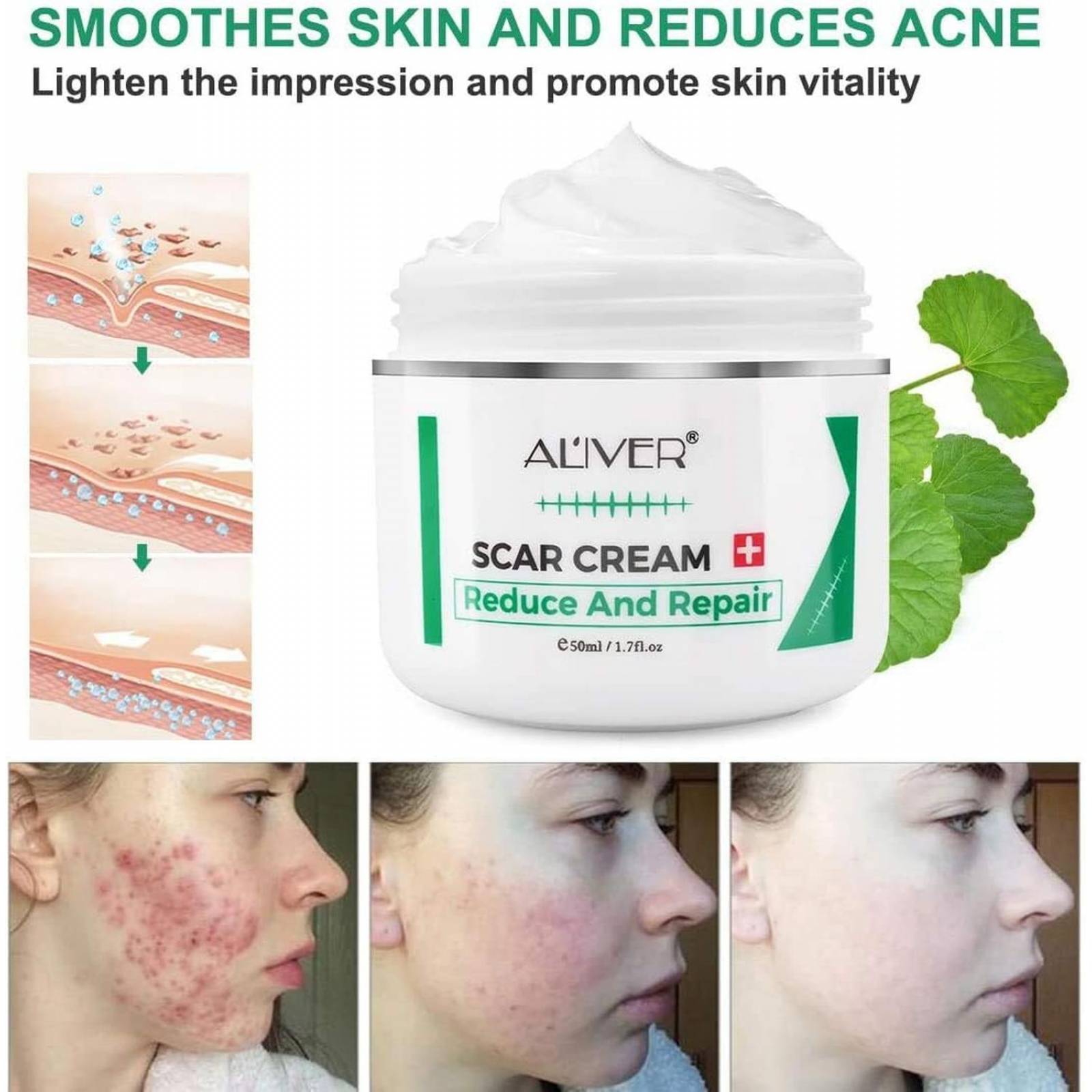 Crema de eliminación de cicatrices para nuevas cicatrices (Aliver) 
