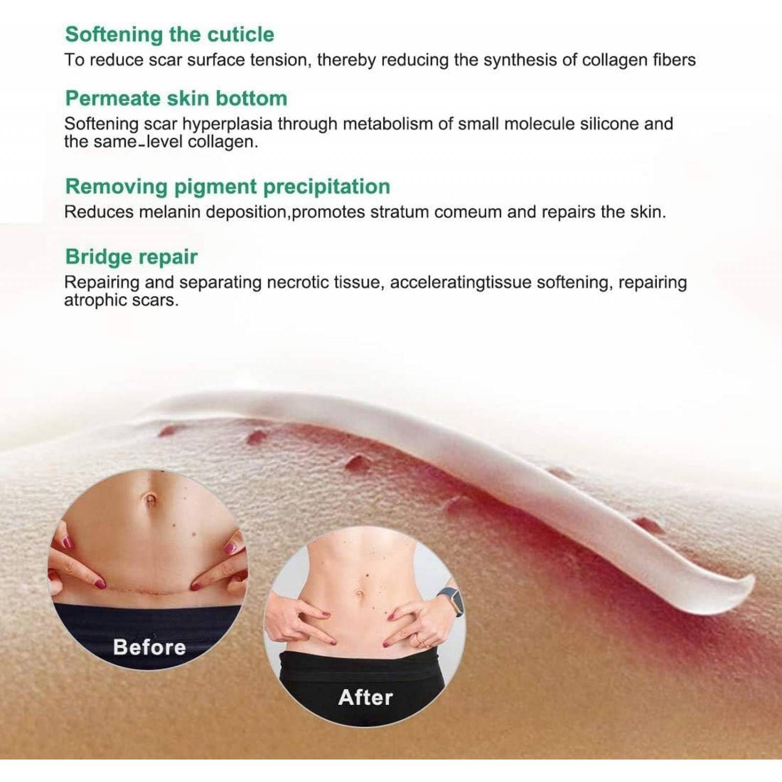 Crema de eliminación de cicatrices para nuevas cicatrices (Aliver) 