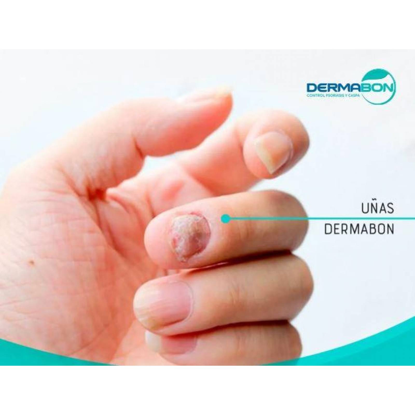 Jabón Para Psoriasis y Dermatitis, Dermabon