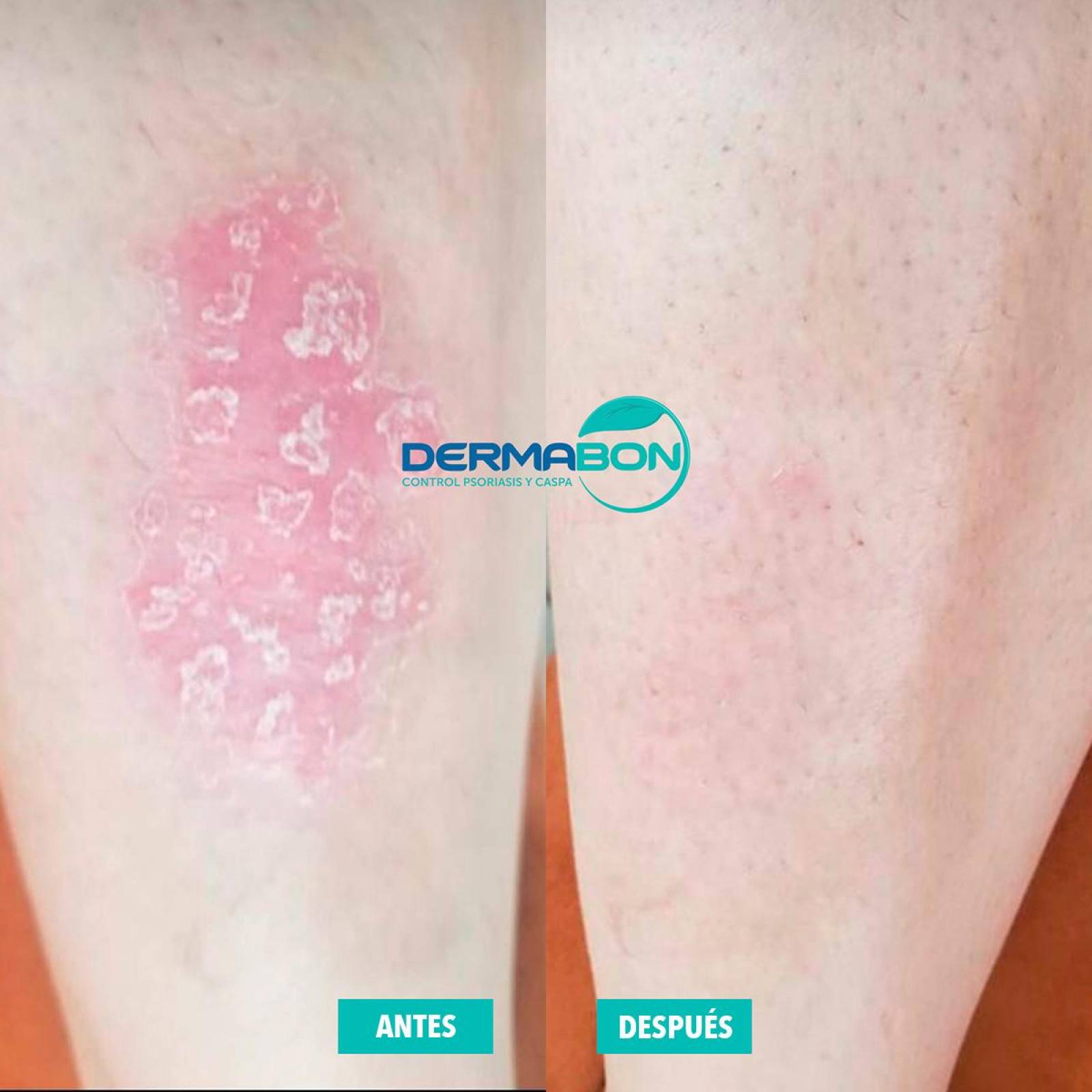 Jabón Para Psoriasis y Dermatitis, Dermabon 1 pza 
