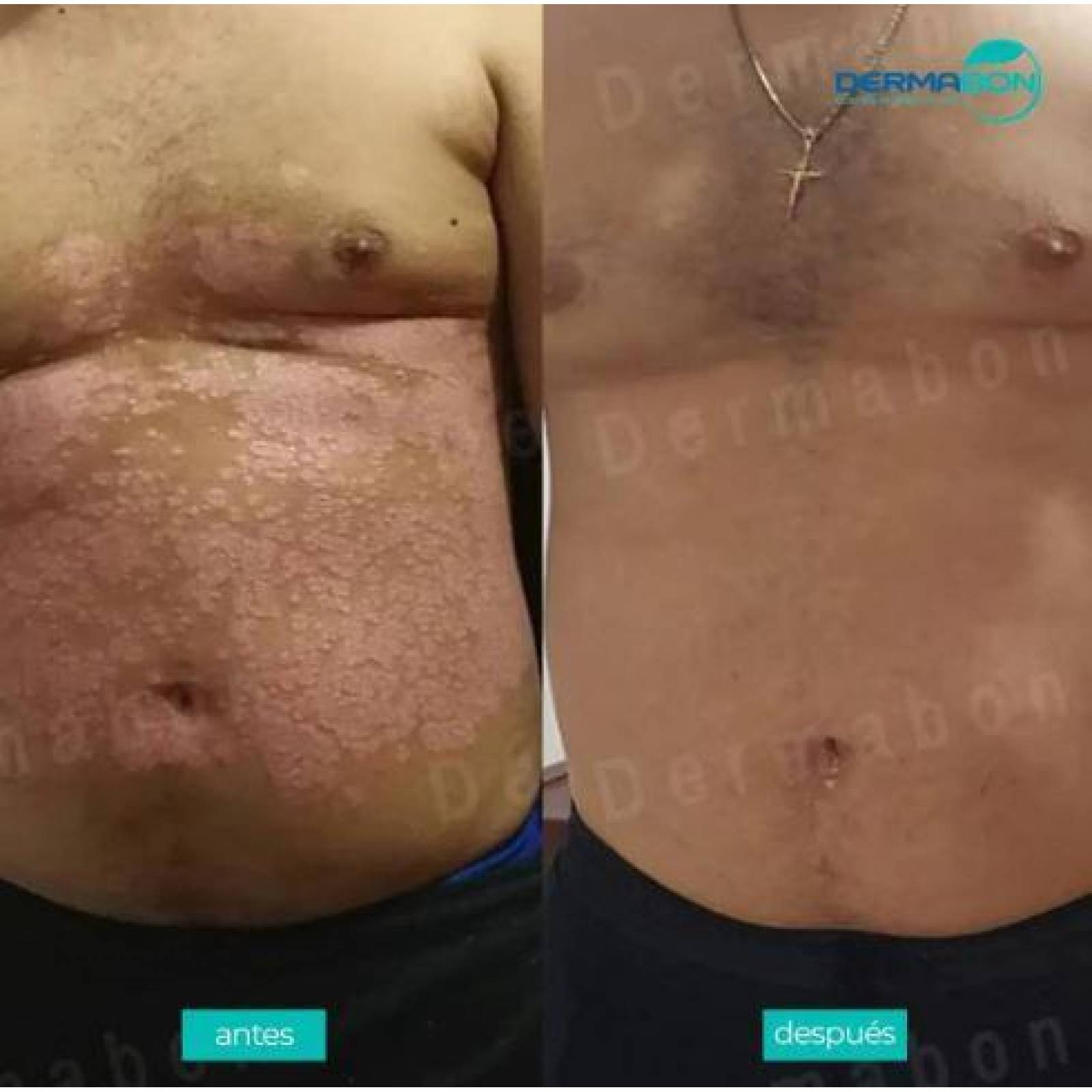 Jabón Para Psoriasis y Dermatitis , Dermabon 6 pzas 