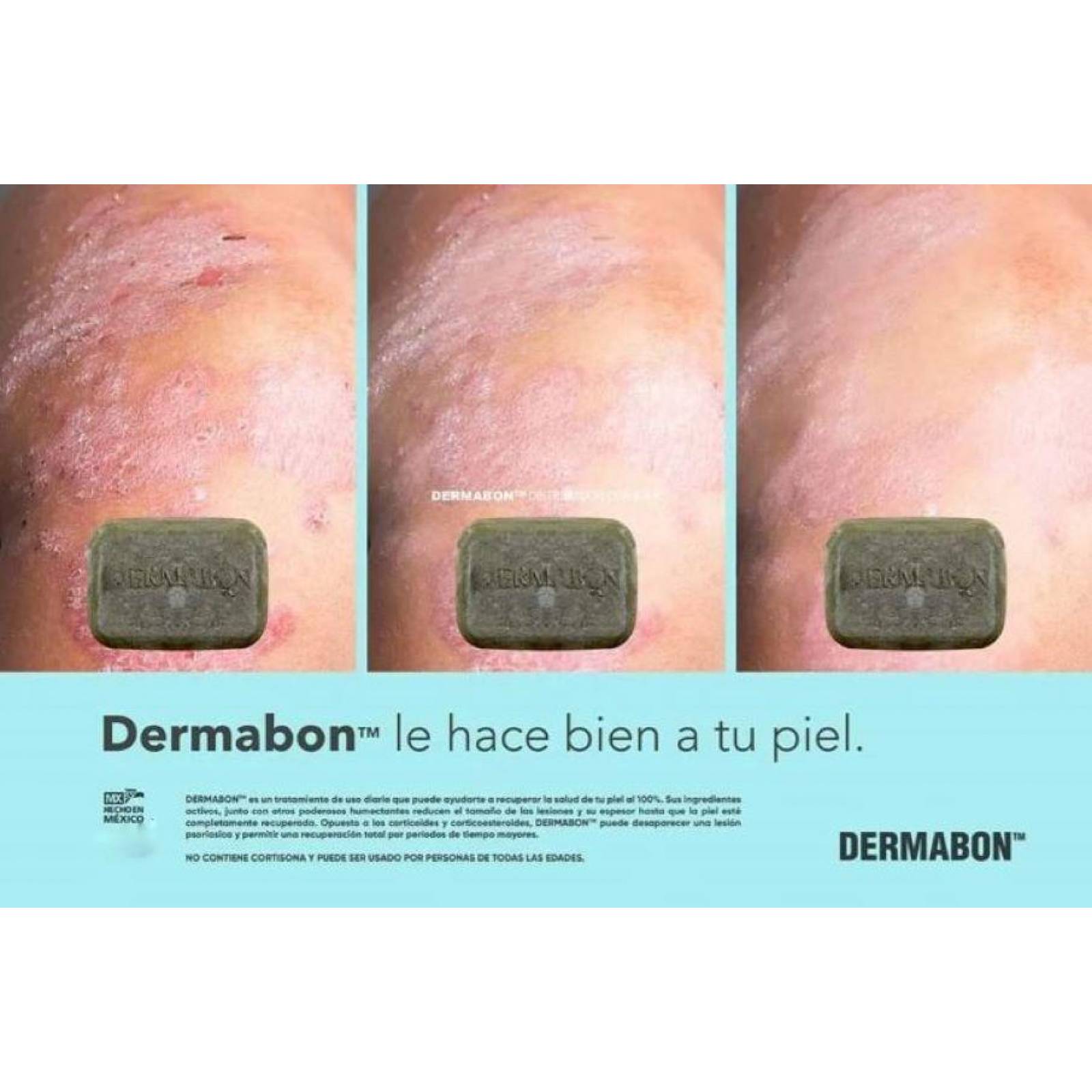 Jabón Para Psoriasis y Dermatitis, Dermabon 3 pzas 