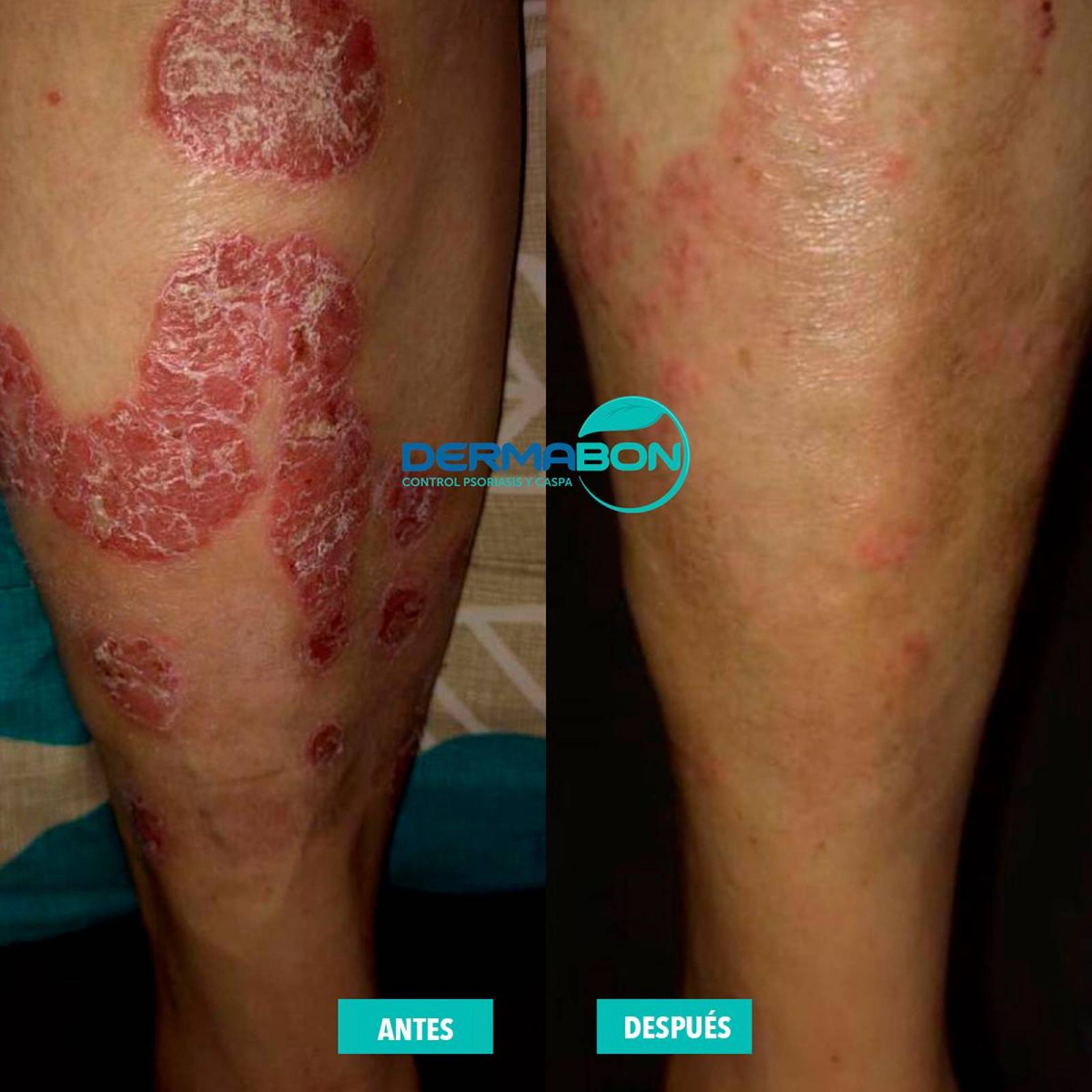 Jabón Para Tratamiento Psoriasis y Dermatitis, Dermabon