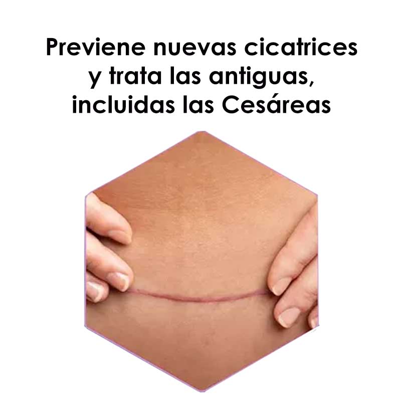 Parches Silicon Para Cicatrices Scaraway 3.8 x 7.6 cm con 8 parches elimina cicatrices