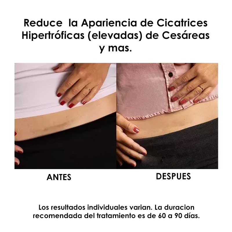 Parches Silicon Para Cicatrices Scaraway 3.8 x 7.6 cm con 8 parches elimina cicatrices