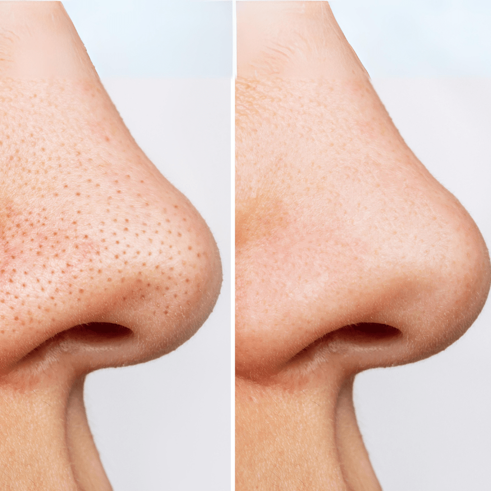 ANUA HEARTLEAF PORE CONTROL CLEANSING OIL 200 ml | Limpiador par control de grasa de poros