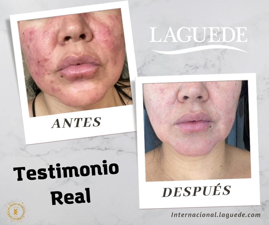 Kit Pieles Sensibles y Rosácea Crema Día + Gel Noche + Jabón Complejo 6 Laguede Piel Seca/Normal  .