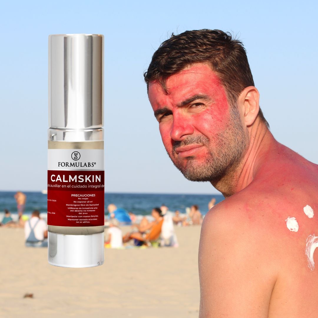 Crema Facial y Corporal, Previene Y Cura Quemaduras De Sol, ayuda a pieles con Psoriasis, dermatitis atópica (eccema), Urticaria, Melasma y Acné activo. 25g - Calmskin- Formulabs