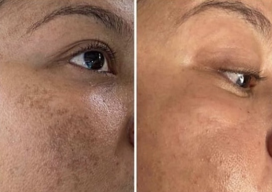 Crema Despigmentante Facial MacAichel SkinCare especial para manchas obscuras y lentigos solares.