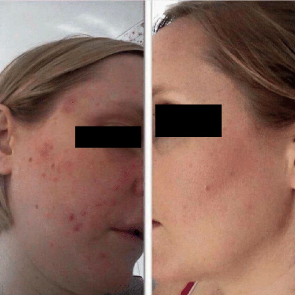 Kit Anti-manchas Ácido Tranexámico y Thanaka. Elimina Manchas Solares y de Acné. Despigmentante y Bloqueador Solar.