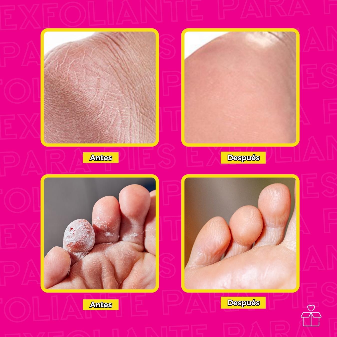 Exfoliante Pies Callos Resequedad Suavidad Repara.