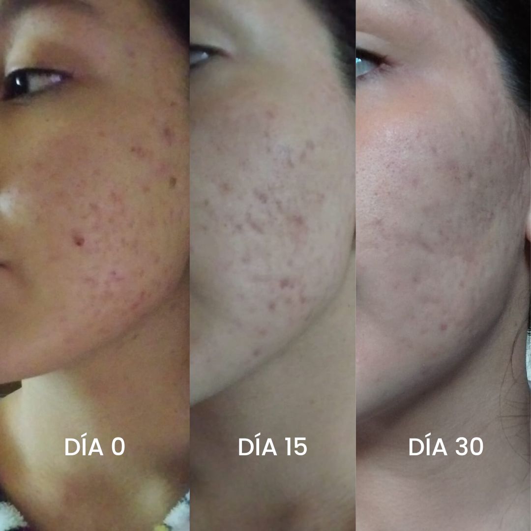 Kit Couple Jabón. Dúo de Jabones para Controlar el Acné y el Brillo Excesivo. Elimina Manchas, Paño y Melasma. Rutina de Día y Noche.