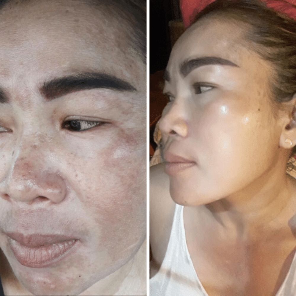 Kit 2 en 1 Aclarante facial. Elimina Manchas, Paño y Arrugas Faciales. Hidratante Facial y Control de Acné