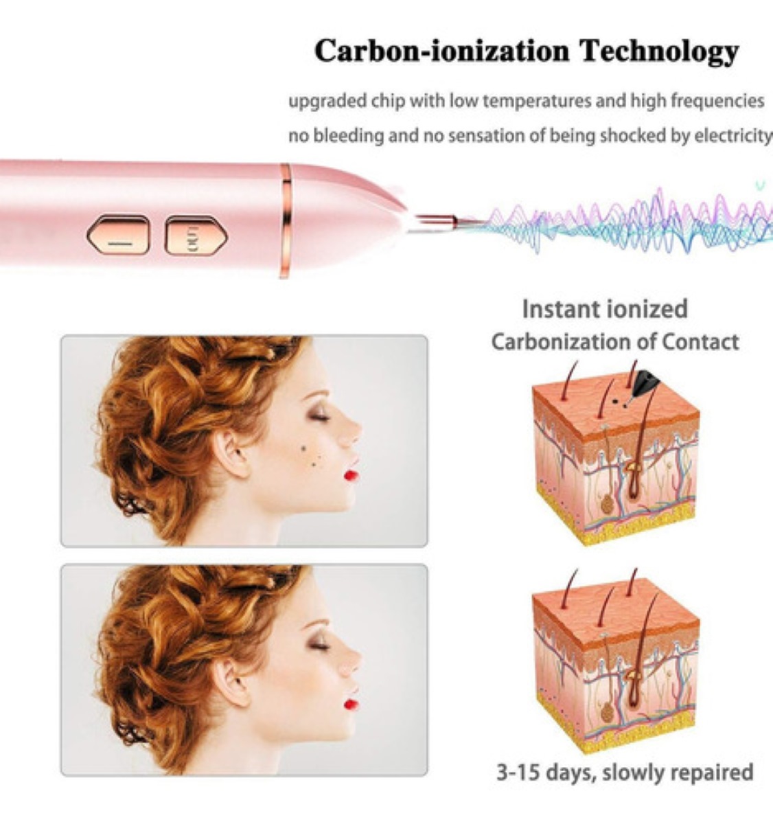 Pluma Cauterizador Removedora Manchas Verrugas Pecas Lunares, Rosa