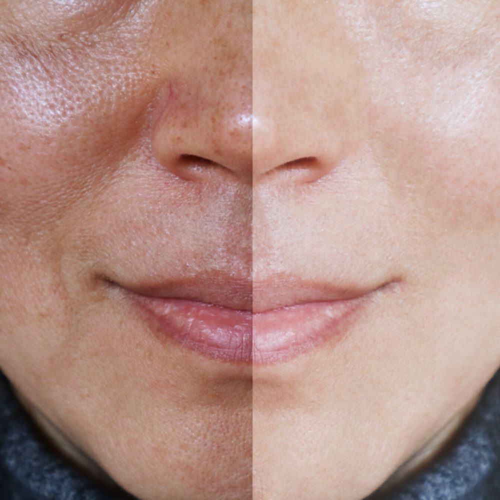 Despigmentante Anti-acne. Piel Libre de Manchas y Acné. Controla el Paño y la Melasma. Sellador Natural y Protección Solar