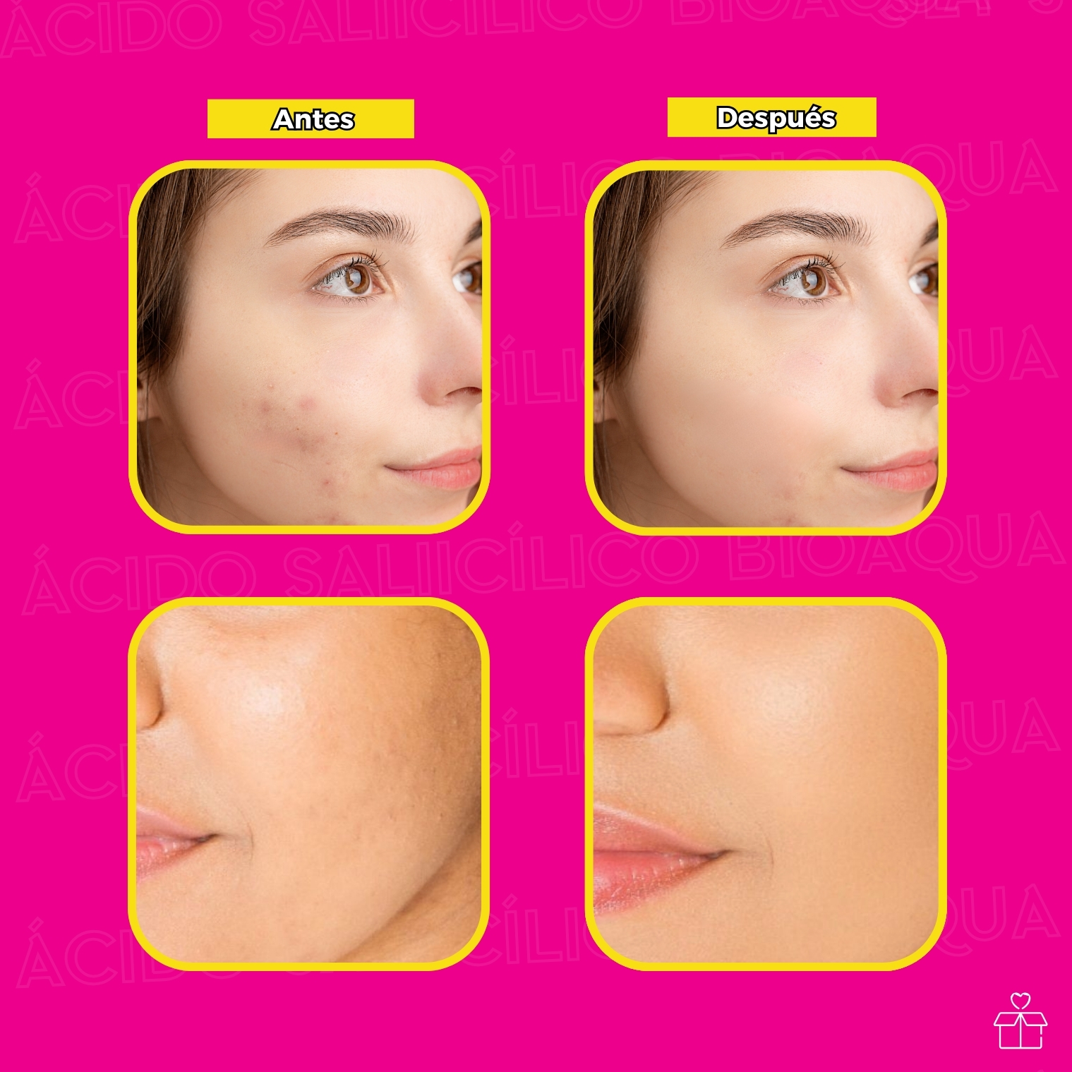 Crema con Ácido Salicílico Para Ácne.