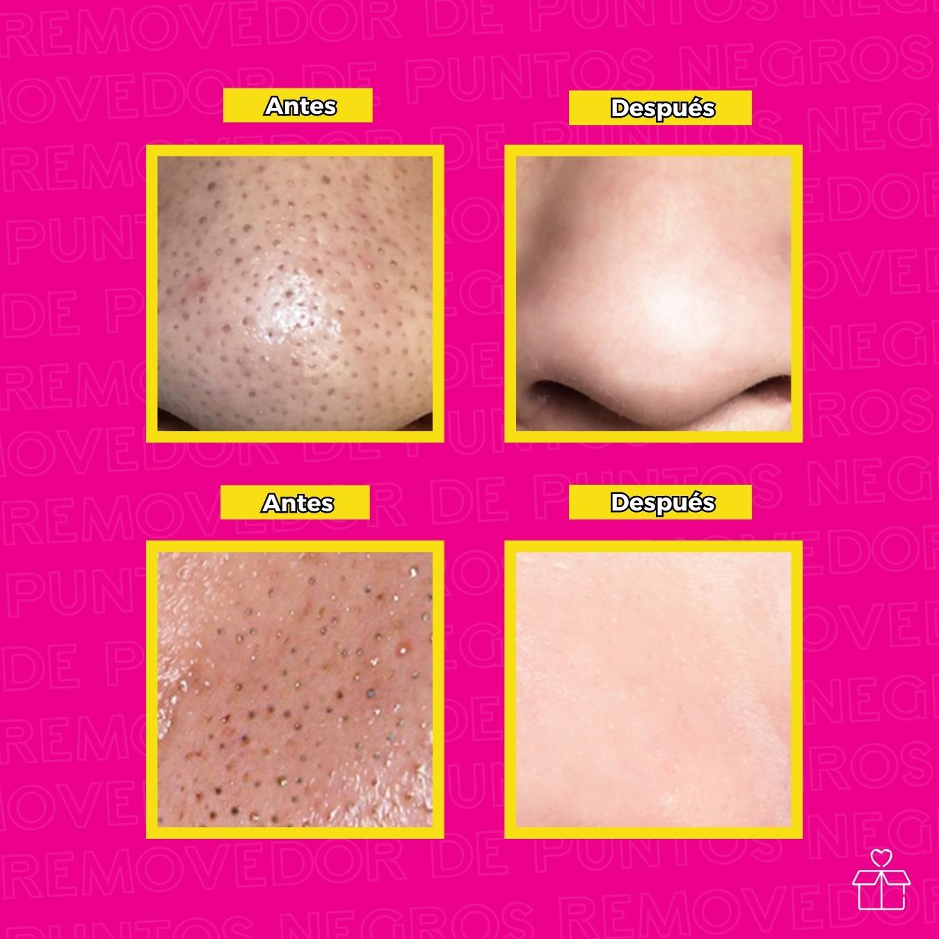 Mascarilla Removedor De Puntos Negros Y Espinillas.