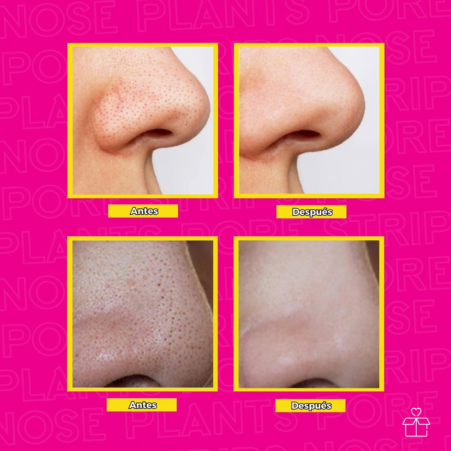 Lanbena Removedor De Puntos Negros.