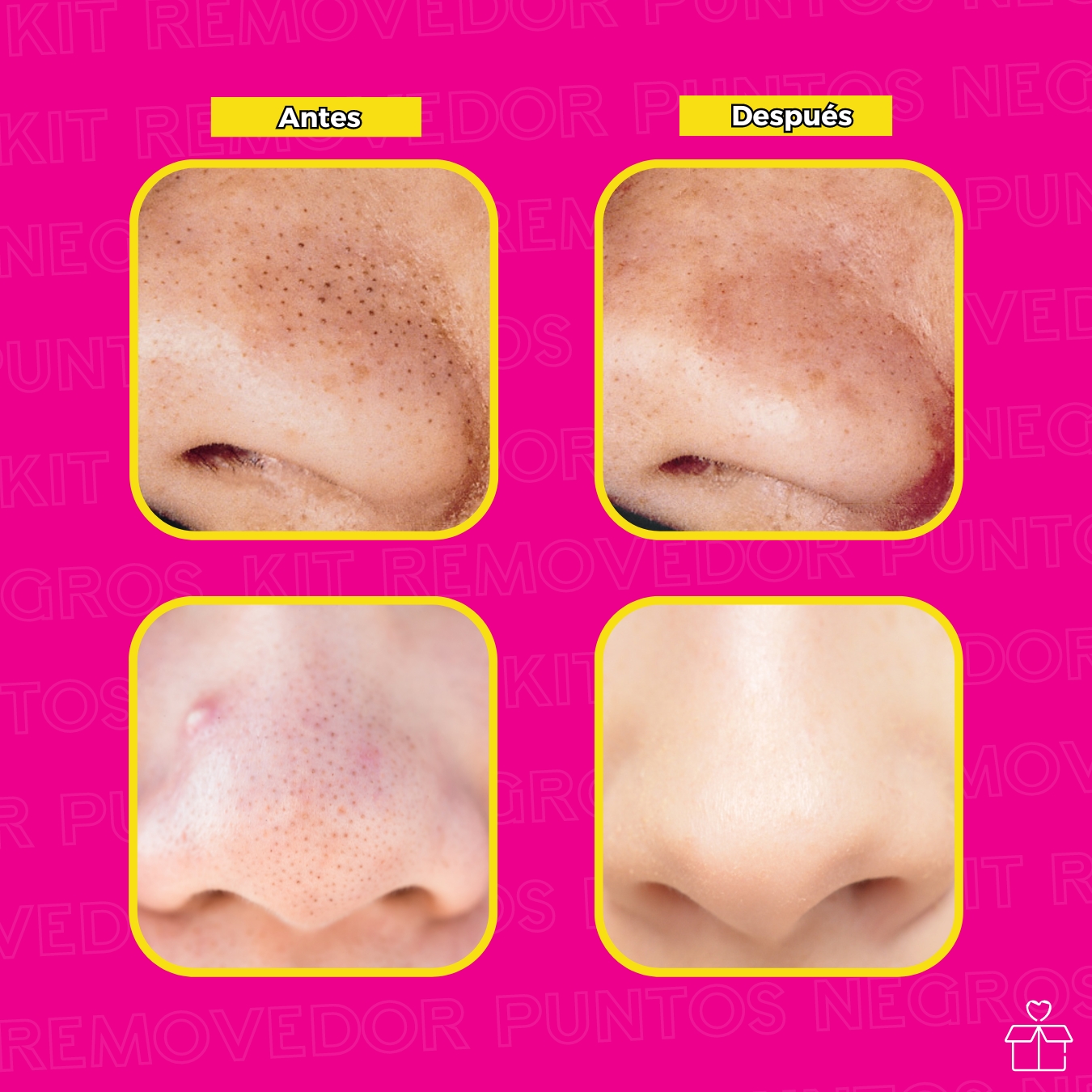 Kit Removedor Acné Y Extractor Espinillas Acero Inoxidable.