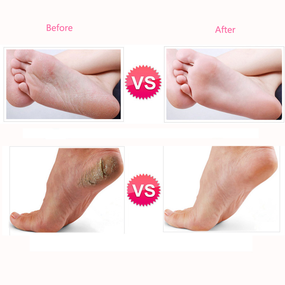 Removedor Eléctrico De Callos Pies Pedicure + 60 Repuestos