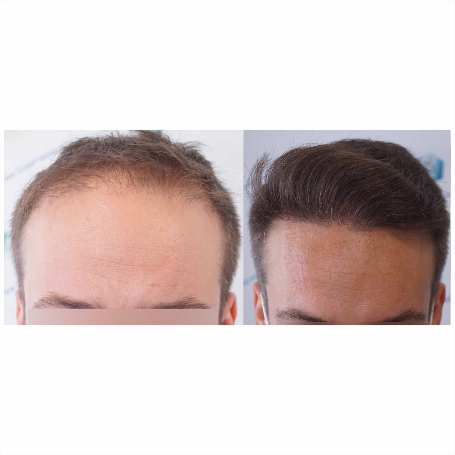 Minoxidil Pastillas 5mg Oral Minoxytop 50 Pastillas Tratamiento capilar y barba