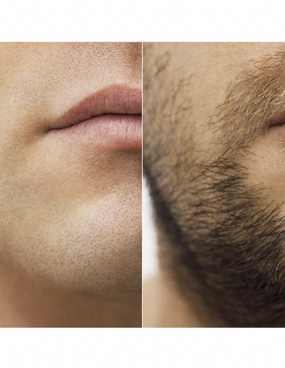 Minoxidil Pastillas 5mg Oral Minoxytop 50 Pastillas Tratamiento capilar y barba