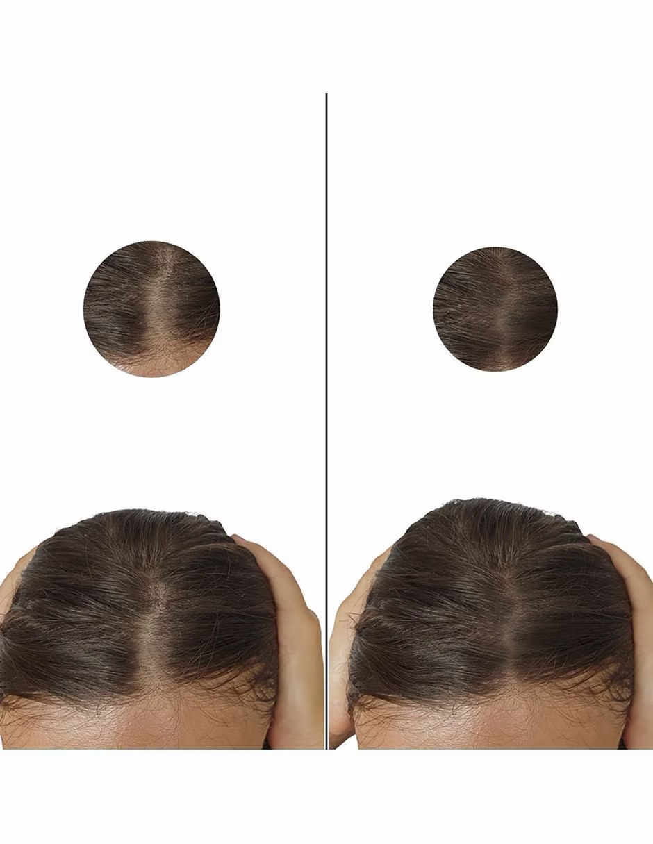 Minoxidil Pastillas 5mg Oral Minoxytop 50 Pastillas Tratamiento capilar y barba