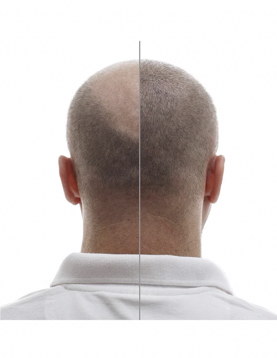 Minoxidil Pastillas 5mg Oral Minoxytop 50 Pastillas Tratamiento capilar y barba