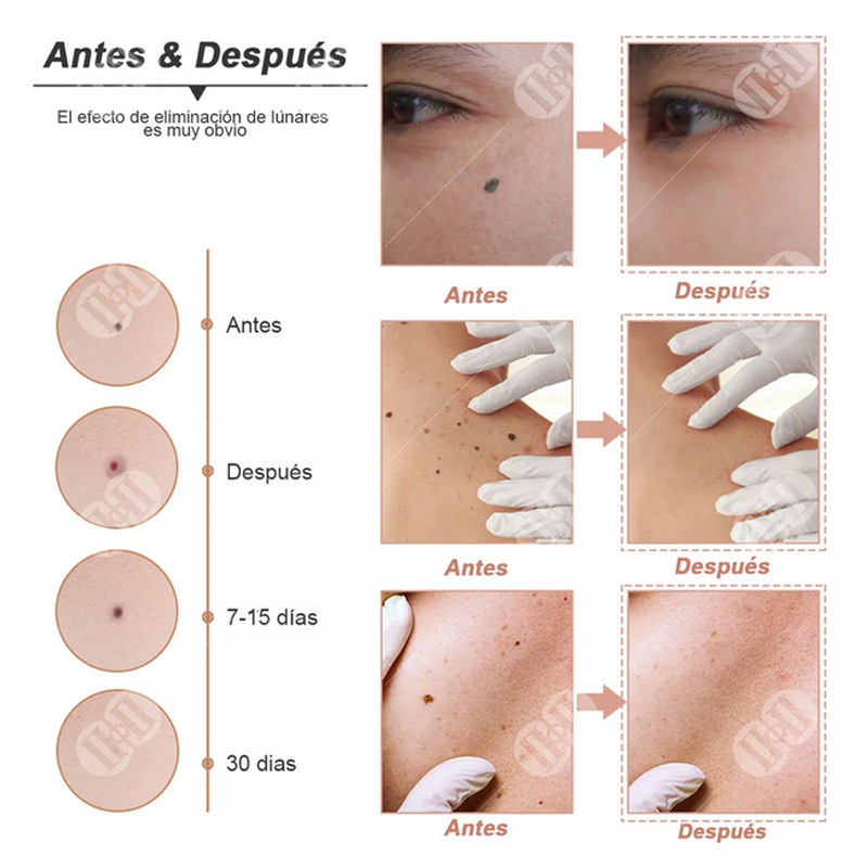 Pluma dermatologica Quita lunares Verrugas Remueve Manchas Pecas Tatuajes