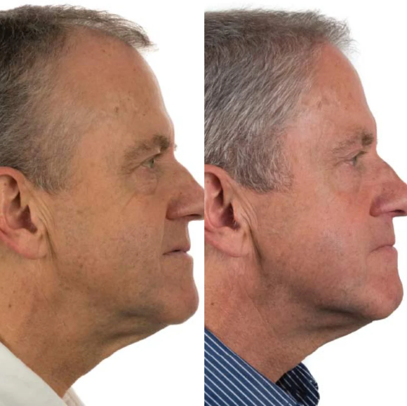 Foligain Shampoo con 2% Triodixil para el Recrecimiento del Cabello en Hombres.